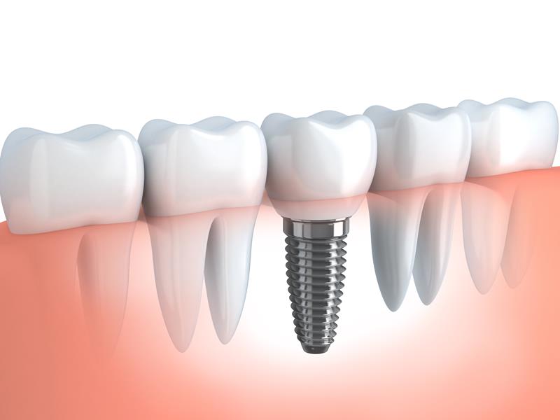 Dental Implants Malibu, CA
